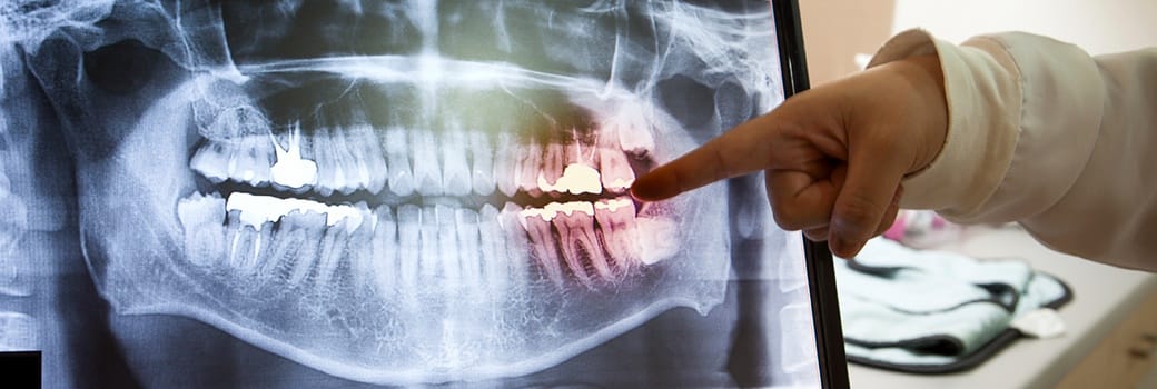 hand pointing to red teeth on x-ray