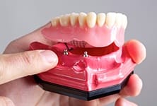 implant supported denture mockup