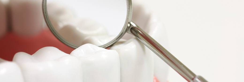 mirror showing dental sealants
