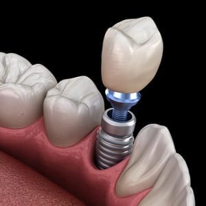 a computer illustration showing the different parts of dental implants