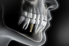 Diagram of how dental implants work in Greensboro