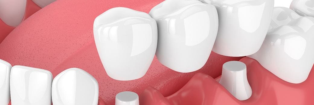Model of an all-ceramic dental bridge and crowns