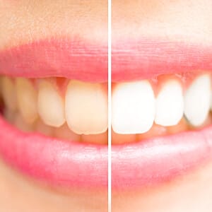 A before and after image of a person who completed teeth whitening