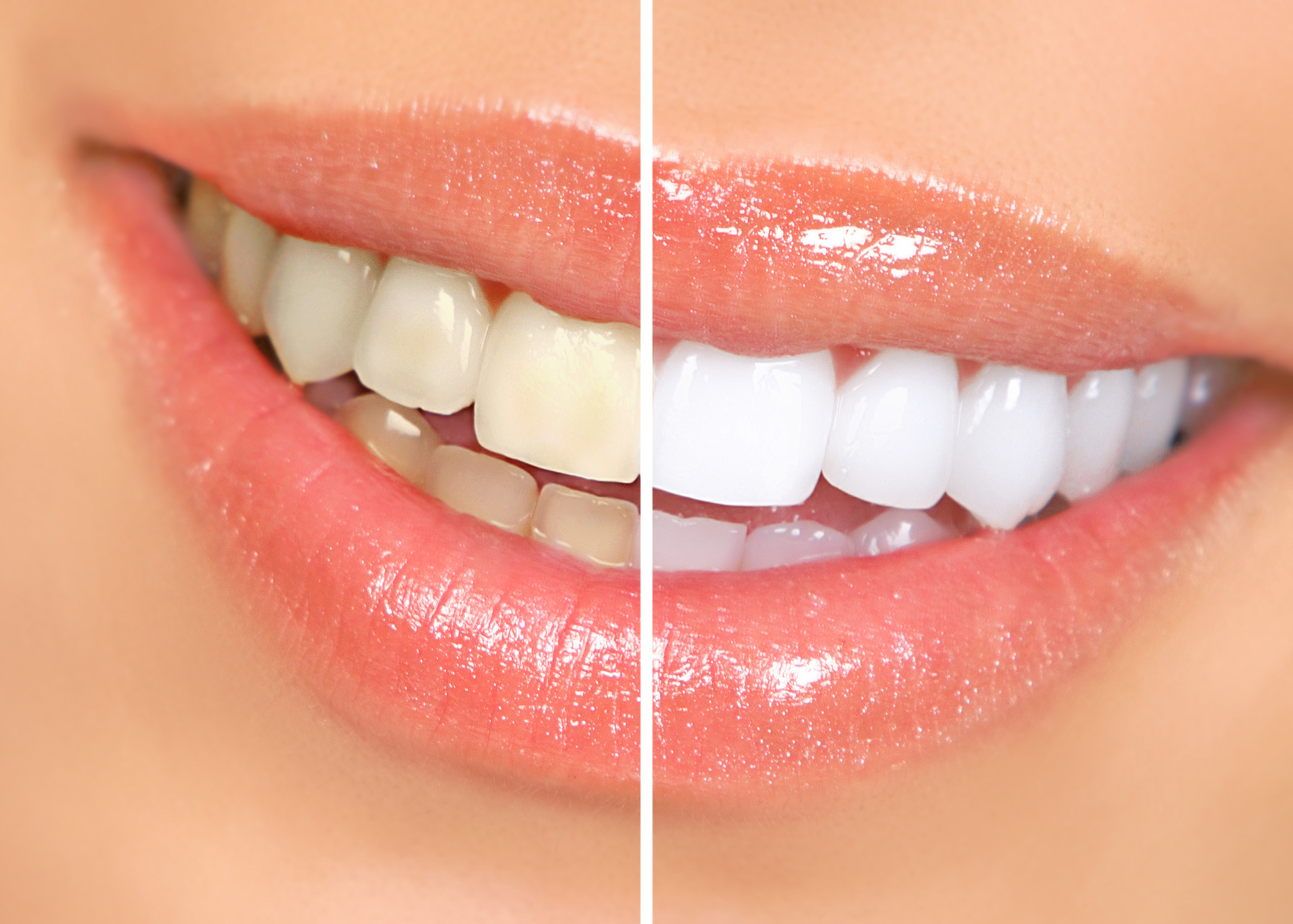 What To Eat What Not To Eat After Teeth Whitening In Greensboro David M Fisher Jr Dds Blog