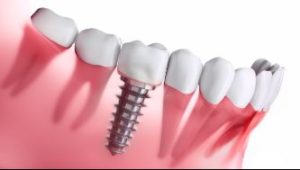 Model of an implant in the lower jaw