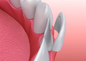 Graphic showing how dental veneers work