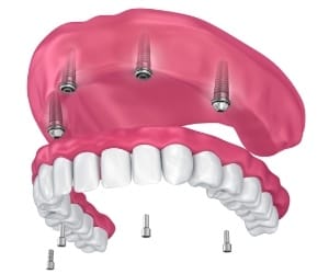 Digital model of implant denture