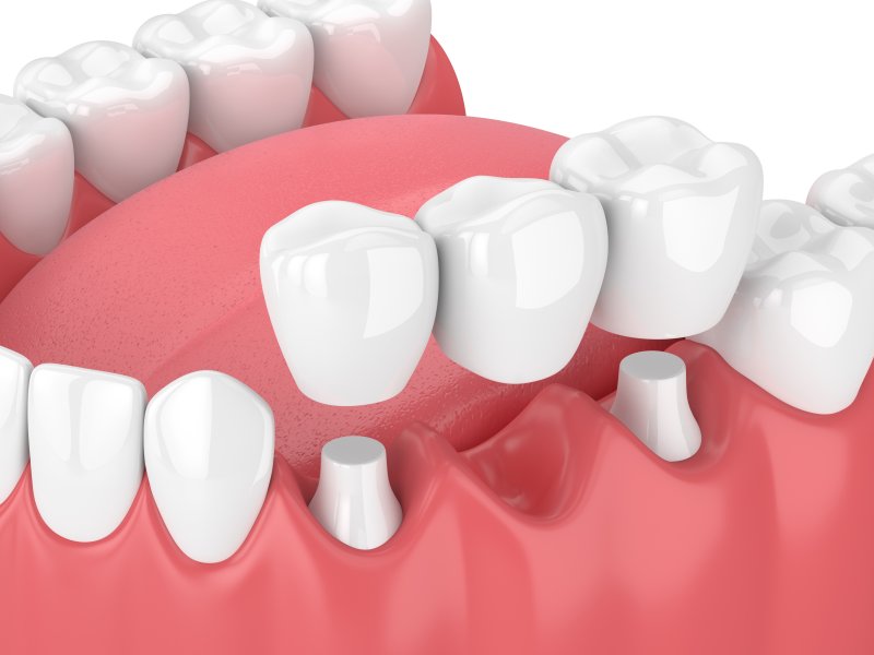 illustration of dental bridge failure in Greensboro