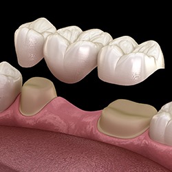 Digital image of fixed dental bridge