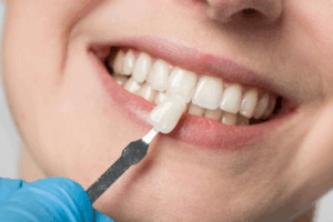 Dentist comparing a veneer to a patient’s natural teeth